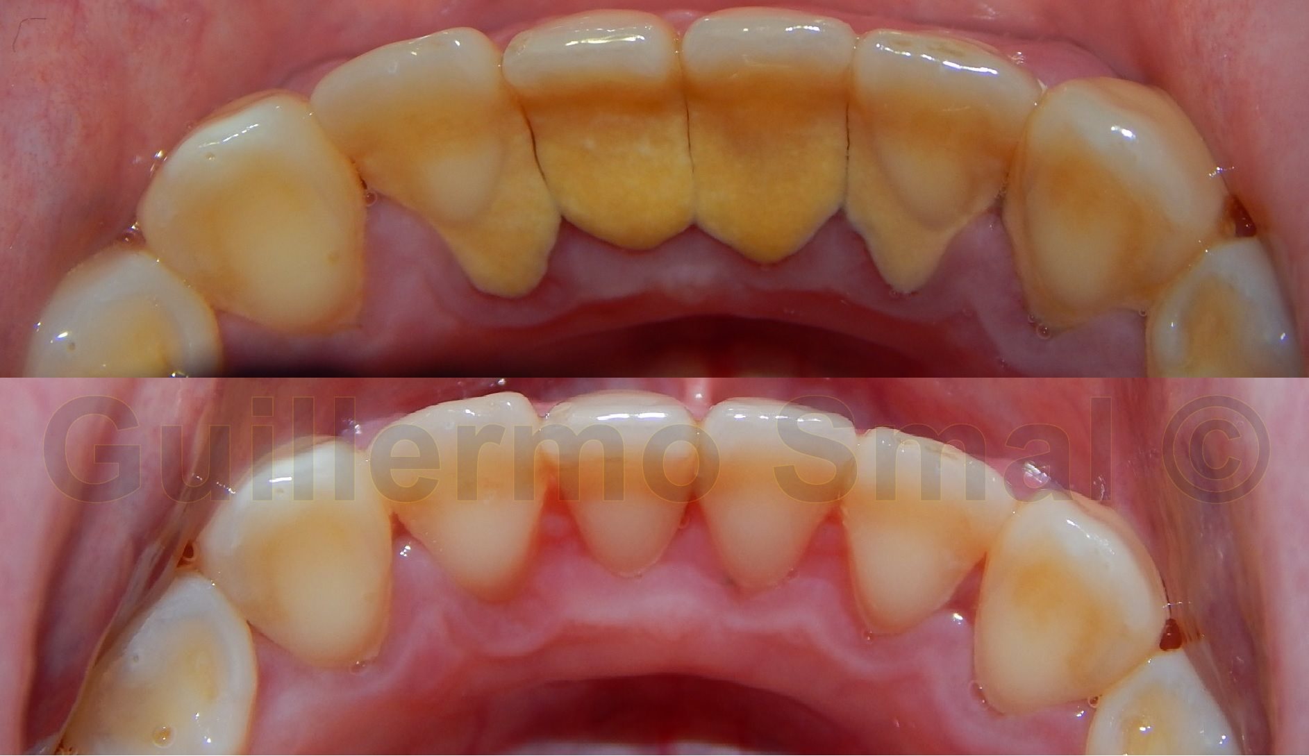 Dental con Ultrasonido – Odontología Guillermo Smal
