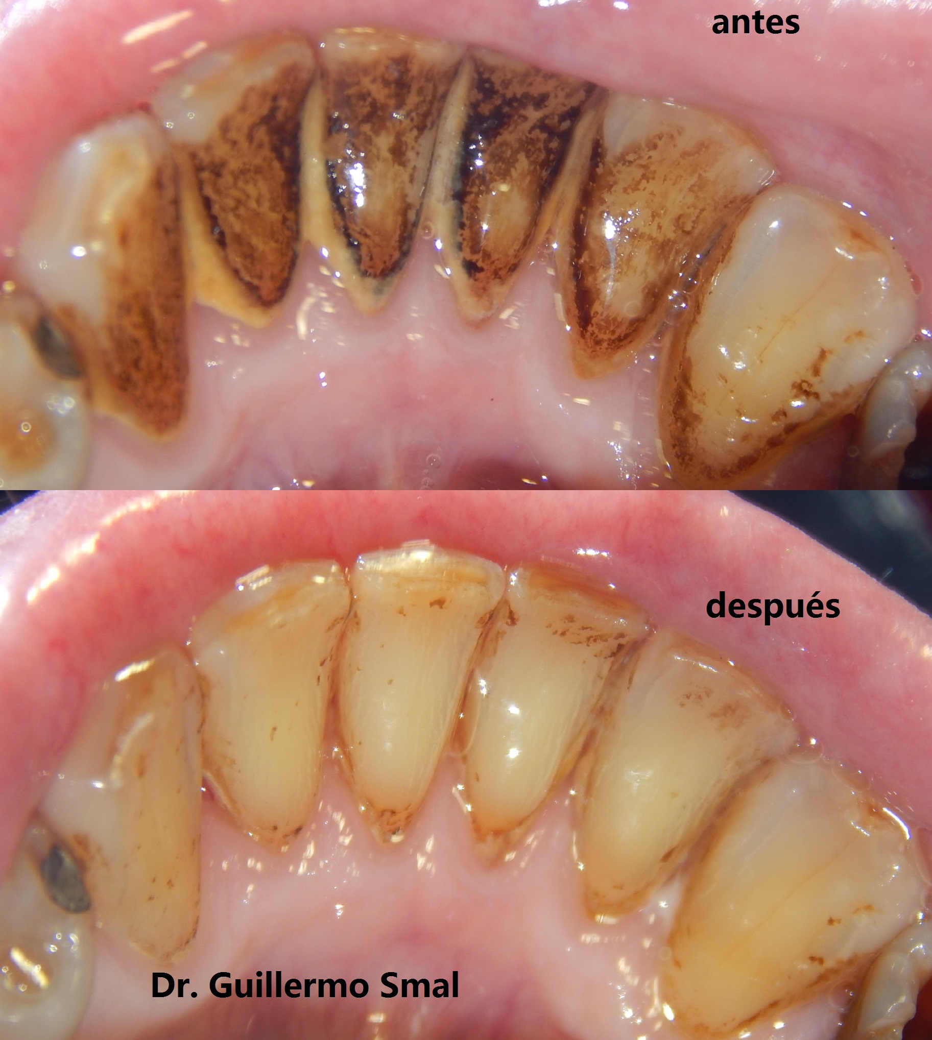 Dental con Ultrasonido – Odontología Guillermo Smal
